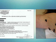 Pacjentka ze zdiagnozowaną zakrzepicą pourazową. Dzięki
pijawkom i właściwie dobranym lekom zaleconym przez lekarza
prowadzącego, okres leczenia skrócił się z kilku miesięcy do
niespełna miesiąca czasu. To kolejny przykład na to, jak medycyna
naturalna i tzw. akademicka mogą się wzajemnie uzupełniać z
korzyścią dla pacjenta. Pijawki były przykładane miejscowo w okolicy dołu pachowego i ramienia. 